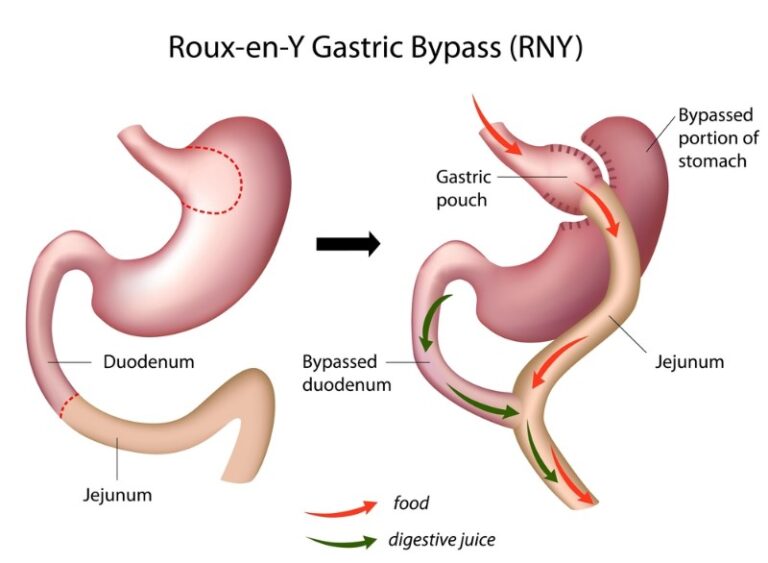 gastric-bypass-surgery-support-groups-sydney